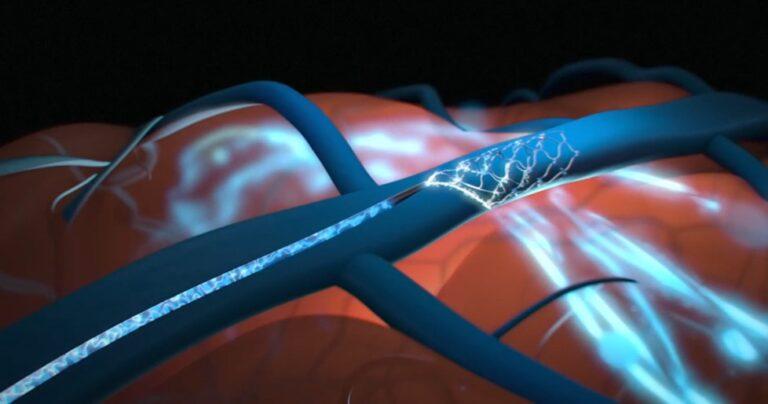 Synchron to invest $75 Mn on its Promising Endovascular Brain Computer Interface Tech